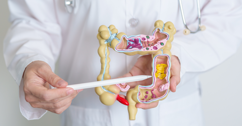 Médico sosteniendo un modelo de colon, representando la detección y prevención del cáncer colorrectal.