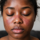 Una persona con los ojos cerrados y rojez en la nariz y mejillas, síntomas de lupus.